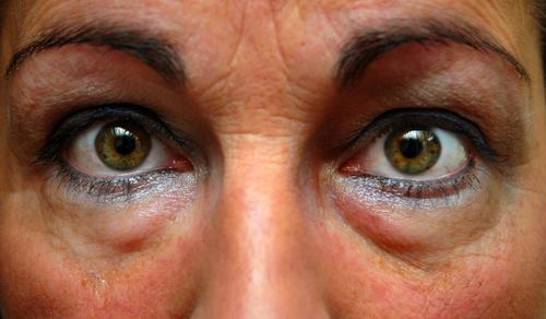 skin-care-eyes