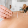 sports acupuncture