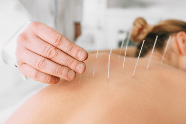 sports acupuncture