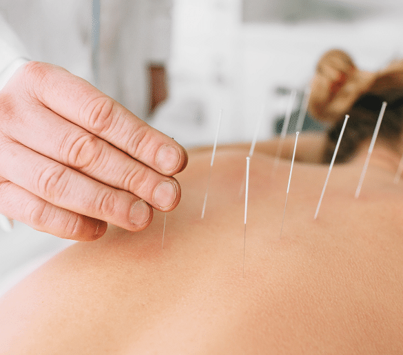 sports acupuncture